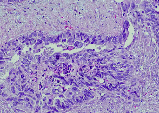 carcinoma seroso, ovario, tejido blando metastásico - ovary human cell cell high scale magnification fotografías e imágenes de stock