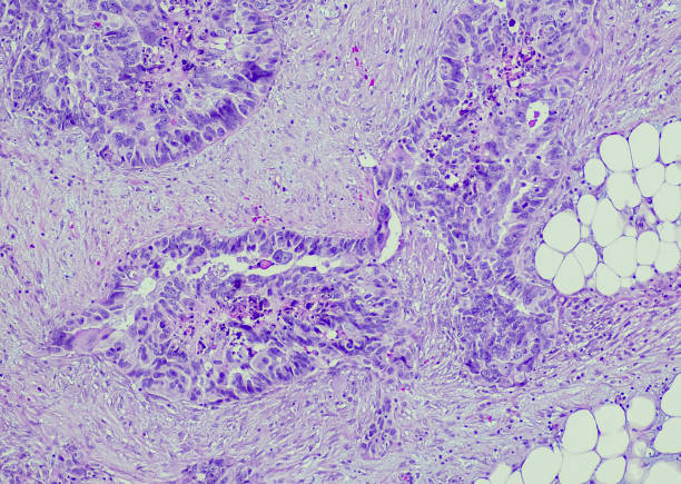 istock Serous carcinoma, ovary, metastatic soft tissue 1413326599
