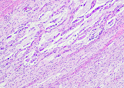 Ganglioneuroblastomas are tumors that develop in your nerve tissue, from “ganglia,” meaning “a mass of nerve cells.” Ganglioneuroblastomas are intermediate tumors, ones that have both malignant and benign cells, or both cancerous and noncancerous cells, respectively.