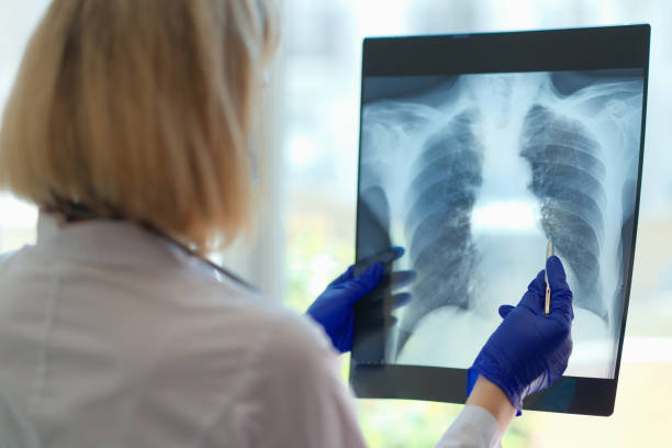 istock Doctor pointing at damaged area on lung x ray 1413372346