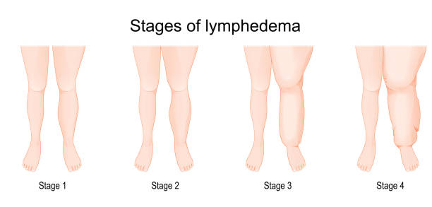 lymphedema stages. vector art illustration