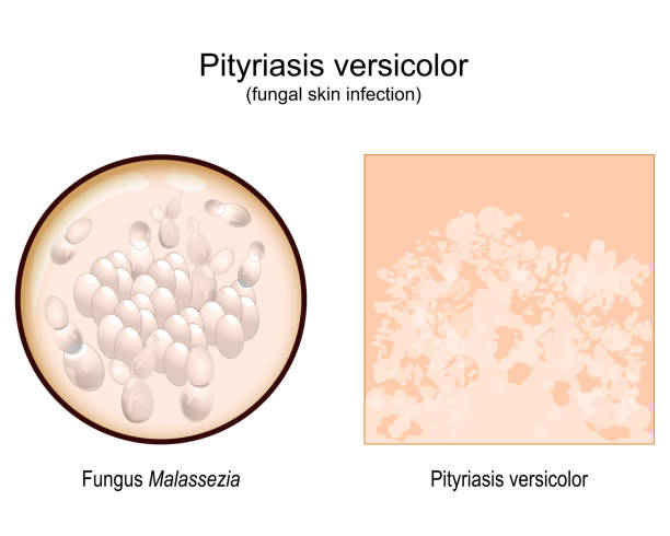 pityriasis versicolor. skin surface. Malassezia fungi pityriasis versicolor. skin surface with Signs and symptoms of Tinea versicolor. Close-up of a Malassezia fungi that caused skin eruption. vector illustration tinea stock illustrations