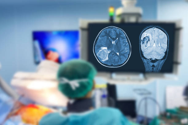 rozmyte zbliżenie na sali operacyjnej, asystent rozdaje instrumenty chirurgom podczas operacji guza mózgu. chirurdzy wykonują operację. - radiogram photographic image zdjęcia i obrazy z banku zdjęć