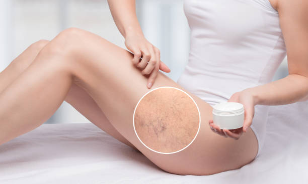 한 여성이 다리에 작은 피부 혈관의 팽창을 치료하기 위해 연고를 바르십시오. 건강 검진 및 telangiectasia의 치료. phlebeurysm. - insufficiency 뉴스 사진 이미지