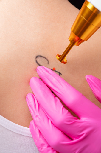 The doctor cosmetologist makes the procedure for laser tattoo removal on the girl's body.