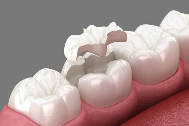 posizionamento della corona in ceramica ad intarsio. illustrazione 3d medicalmente accurata del trattamento dei denti umani - inlaid foto e immagini stock