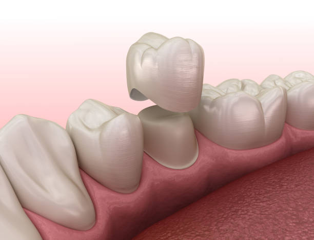 istock Preparated premolar tooth and dental crown placement. Dental 3D illustration 1413573923