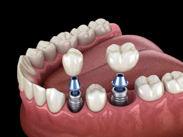 premolar and molar tooth crown installation over implant, screw fixation. 3d illustration of dental treatment - implantat imagens e fotografias de stock