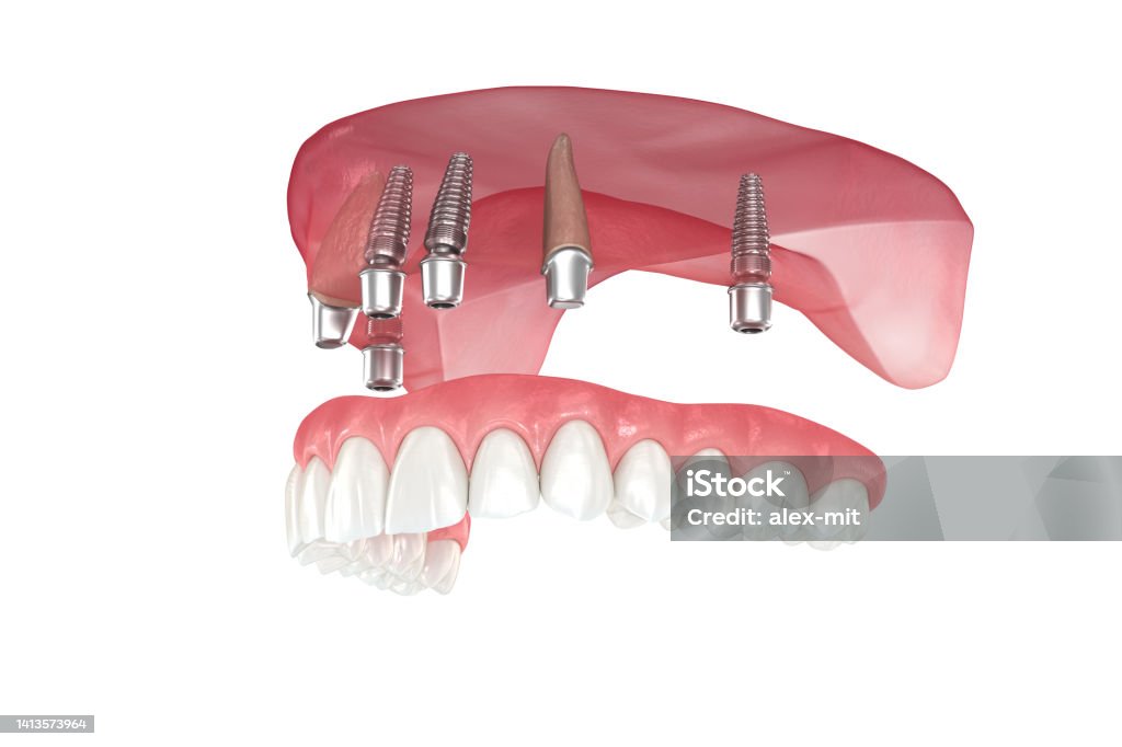 Maxillary Prosthesis Maxillary Prosthesis Supported By 2 Teeth And 4 Implants Dental 3d ...