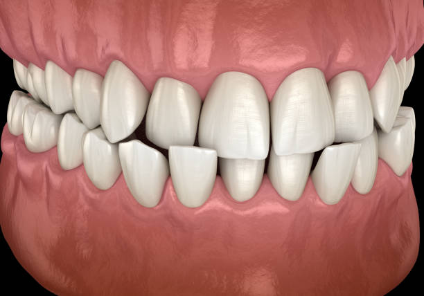istock Anterior crossbite dental occlusion ( Malocclusion of teeth ). Medically accurate tooth 3D illustration 1413573980