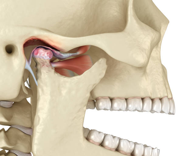 Temporomandibular joints arthritis and dislocated articular disc. Medically accurate 3D illustration. Temporomandibular joints arthritis and dislocated articular disc. Medically accurate 3D illustration. jaw pain stock pictures, royalty-free photos & images