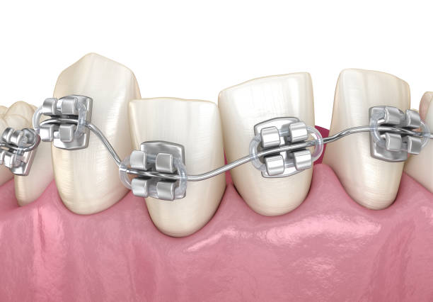 istock Abnormal teeth position and correction with metal braces tretament. Medically accurate dental 3D illustration 1413574042