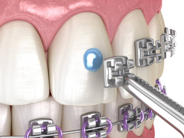 istock Metal braces installation process. Dental 3D illustration 1413574045