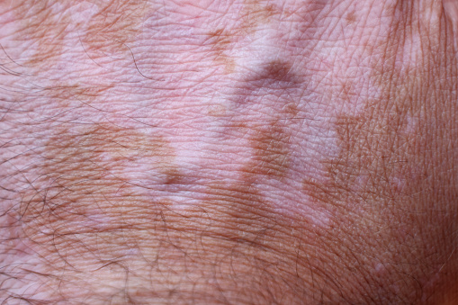 Close up of human hand with vitiligo