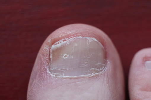 A chiropodist treats the cuticles on the toes with a mechanical device with an abrasive nozzle. Close-up, top view. The concept of chiropody and salon care feet.