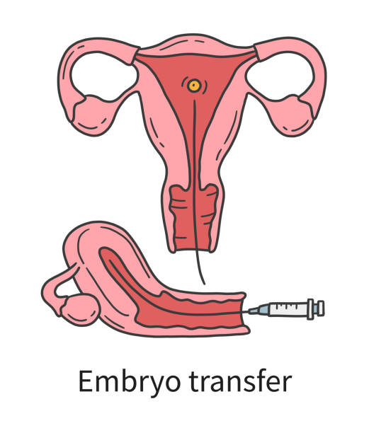 ilustrações de stock, clip art, desenhos animados e ícones de embryo transfer into a woman's uterus at in vitro fertilization - artificial insemination