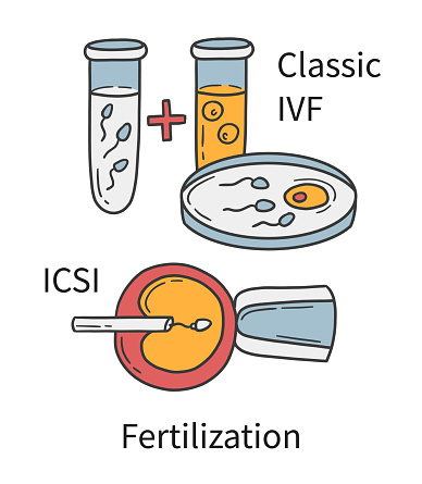 In Vitro fertilization IVF of embryo and sperm in glass or petri dish, Intracytoplasmic sperm injection ICSI. Medical procedure vector illustration in doodle hand drawn style