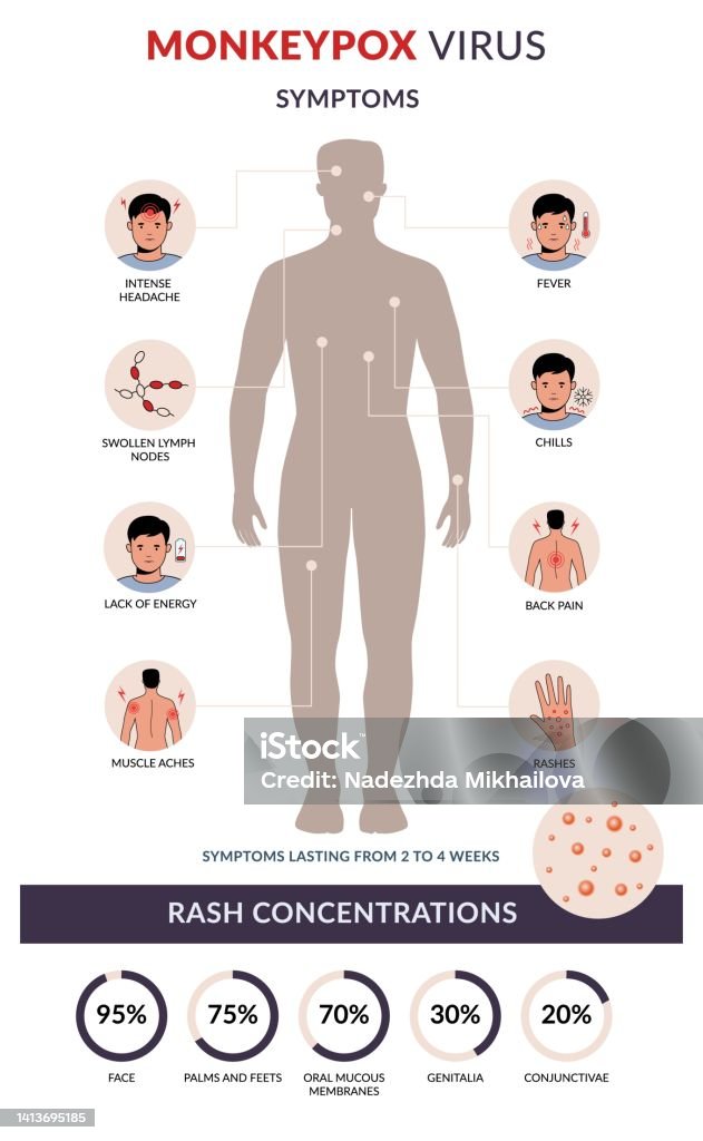 Monkeypox First Rash Monkeypox Virus Symptoms Flat Vector Infographic Rash Concentration ...