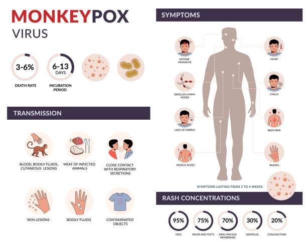 monkeypox virus transmission, symptoms, rash concentration vector infographic with icons. infection spreading from monkey. flat design - 猴痘 插圖 幅插畫檔、美工圖案、卡通及圖標