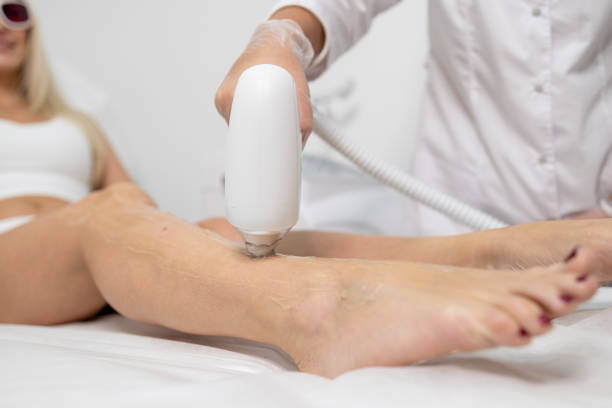 cosmétologue effectuant une procédure d’épilation au laser sur la jambe de la femme. - laser hair removal photos et images de collection