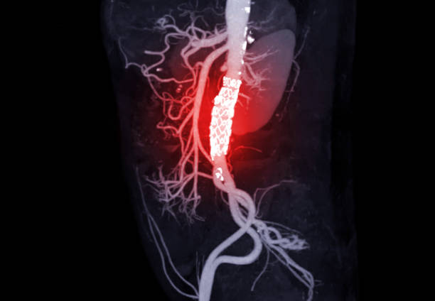 CTA of the abdominal aorta . CTA of the abdominal aorta with stent-grafting in patient Abdominal aortic aneurysm. Aortic Aneurysm stock pictures, royalty-free photos & images