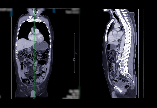 CT SCAN of Chest and Abdomen Coronal and sagittal view with injection contrast media for diagnosis chest and abdomen disease.