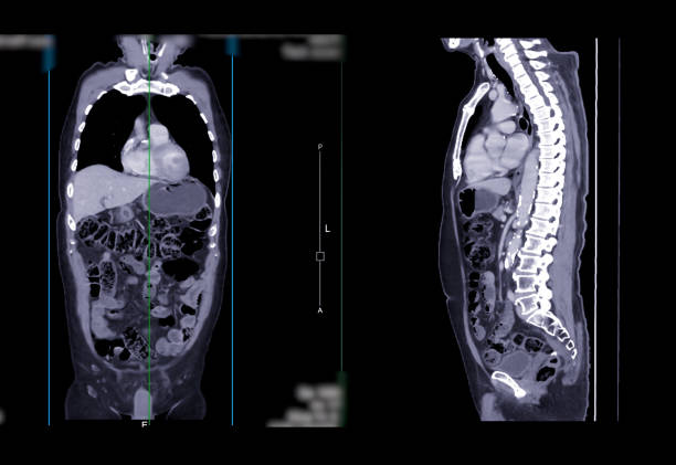 CT SCAN of Chest and Abdomen Coronal and sagittal view. CT SCAN of Chest and Abdomen Coronal and sagittal view with injection contrast media for diagnosis chest and abdomen disease. abdominal cavity stock pictures, royalty-free photos & images