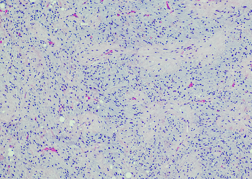 Lipoma pleomórfico de células fusiformes photo
