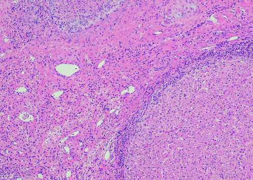 Focal nodular hyperplasia (FNH) is a benign liver lesion that is composed of a proliferation of hyperplastic hepatocytes surrounding a central stellate scar. Typically, FNH is a solitary lesion that is more commonly seen in women.