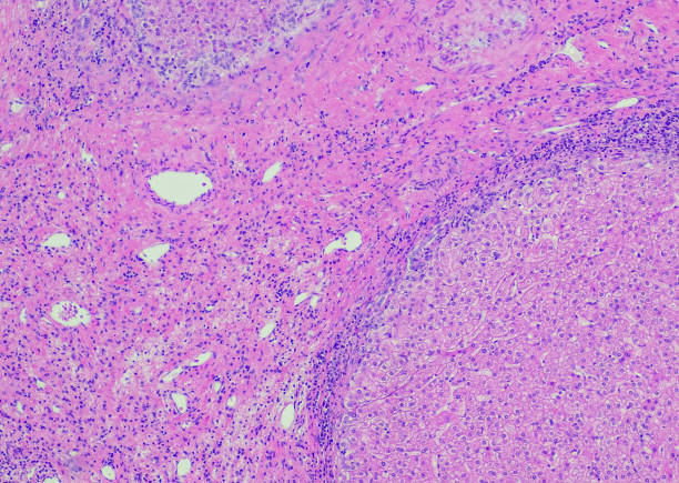 Focal nodular hyperplasia, liver Focal nodular hyperplasia (FNH) is a benign liver lesion that is composed of a proliferation of hyperplastic hepatocytes surrounding a central stellate scar. Typically, FNH is a solitary lesion that is more commonly seen in women. human tissue stock pictures, royalty-free photos & images
