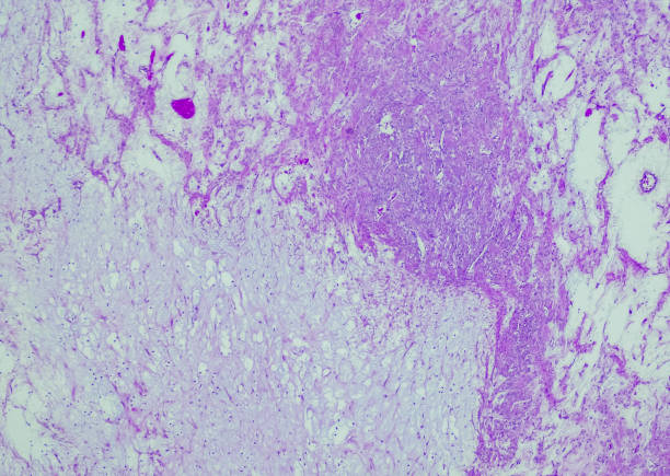 tumor estromal de slerosing - ovary human cell cell high scale magnification fotografías e imágenes de stock