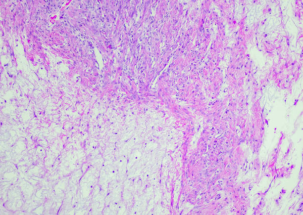 tumor estromal de slerosing - ovary human cell cell high scale magnification fotografías e imágenes de stock