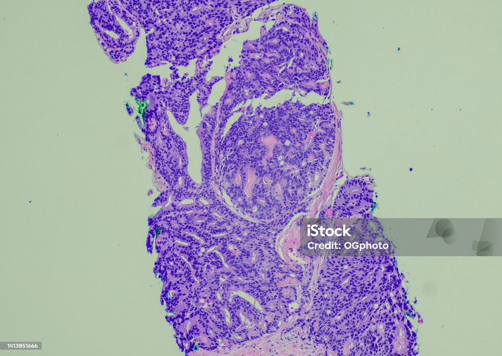 Prostate Pattern 4 Patterns Prostatic Adenocarcinoma Gleason Pattern 4 Stock Photo - Download Image ...