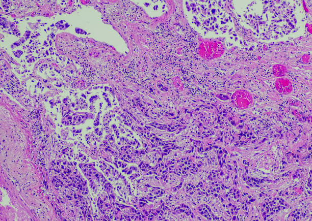 squamous cell carcinoma, lung stock photo