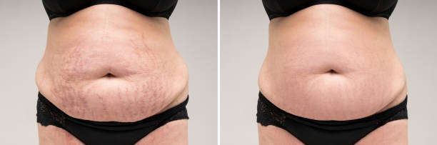 Before and after removing stretch marks from the skin, fat flabby female belly on gray background stock photo