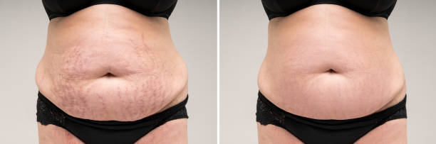 before and after removing stretch marks from the skin, fat flabby female belly on gray background - overweight tummy tuck abdomen body imagens e fotografias de stock