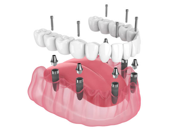 istock 3d render of mandibular prosthesis all-on-6 system supported by implants 1413978585