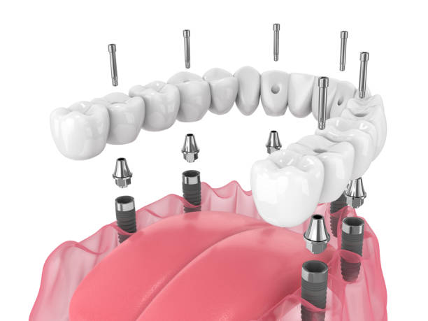istock 3d render of mandibular prosthesis all-on-6 system supported by implants 1413978589