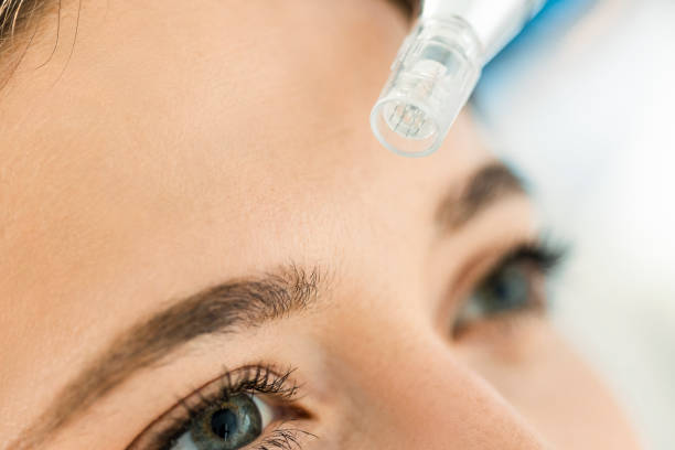 front en gros plan, traitement d’aiguilletage de la peau dermapen sur la peau d’un patient - microneedling photos et images de collection