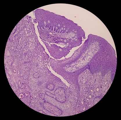 Microscopic tissue of retromolar region, show buccal mucosa, squamous hyperplasia with ulceration, mesenchymal element, blood vessel. Hamartomatous lesion.