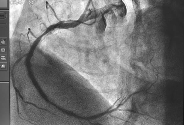 冠状血管造影。 - surgery catheter cardiac catheterization hospital ストックフォトと画像
