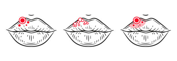 Herpes virus rash on lips, labial sore, inflammation skin face, stomatitis mouth line icon. Blister, ulcer, red acne, facial allergy reaction. Oral infection disease medical treatment. Skincare vector Herpes virus rash on lips, labial sore, inflammation skin face, stomatitis on woman mouth line icon set. Blister, ulcer, red acne. Irritation, redness facial allergy reaction. Oral infection, fungal disease. Dermatology skincare problem. Antiviral medical treatment. Outline vector sti stock illustrations