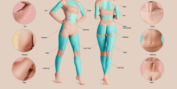 poster con corpo femminile con aree contrassegnate per le procedure di sollevamento. grasso di base problemi aree del corpo umano. - liposuction foto e immagini stock