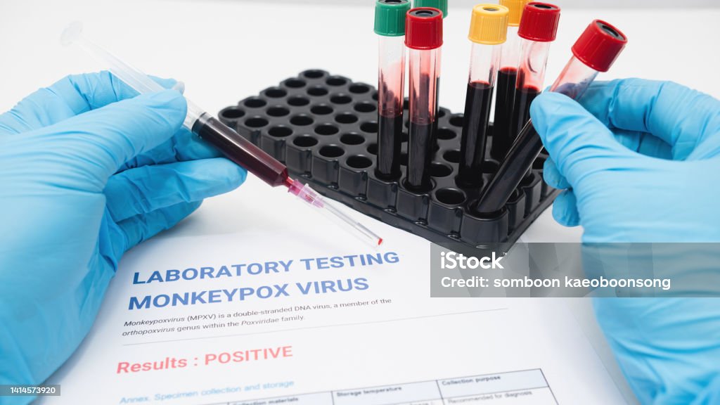 Monkeypox Testing Video Concept Detecting Monkeypox In The Laboratory Syringes Blood Sampling ...