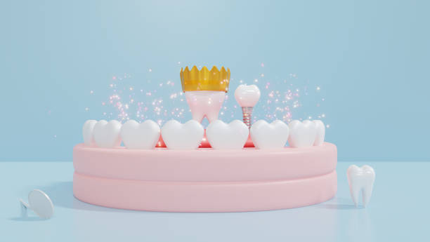 istock Dental Implants surgery concept, dentistry denture, Gold crown in molar teeth with dental implants on denture gums and blue background. 3D render. 1414603705