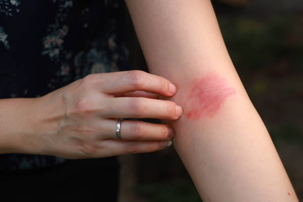 Eczema allergy skin, atopic dermatitis stock photo