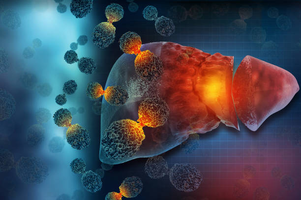 istock Liver cancer. 3d rendered medically accurate illustration 1414624168