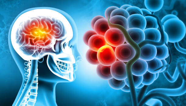 istock Brain injury, damage, disease, 3d illustration 1414626889