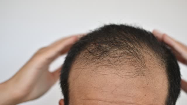 Gros plan d’un homme asiatique non identifié inquiet de sa perte de cheveux  et de son problème de calvitie. Clip Vidéo 1414634920
