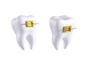 Teeth with or without golden braces. Arch braces without teeth. Orthodontic dentistry. The alignment of the teeth. Healthy lifestyle and dental care. Beautiful white teeth. 3d render